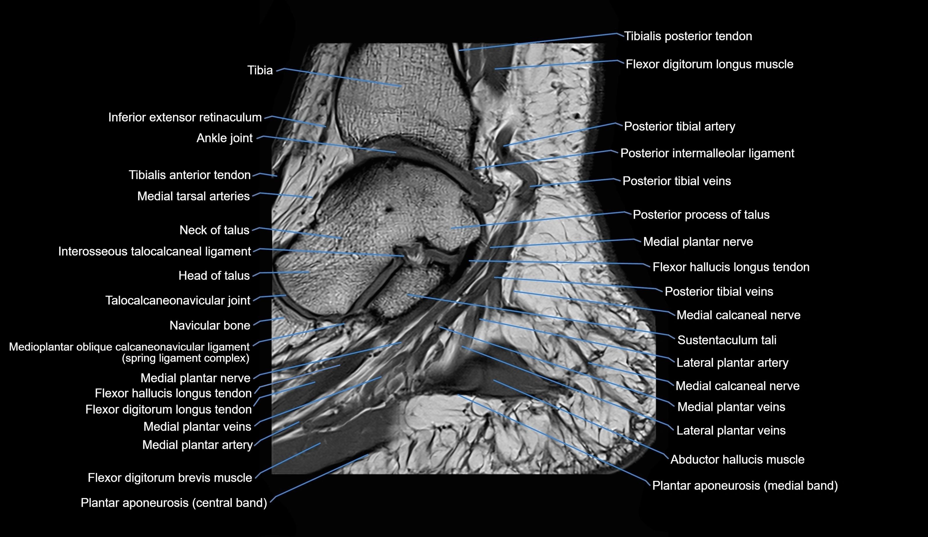 MRI Ankle sagittal cross sectional anatomy 3T  radiology  image-img-00001-00011.webp